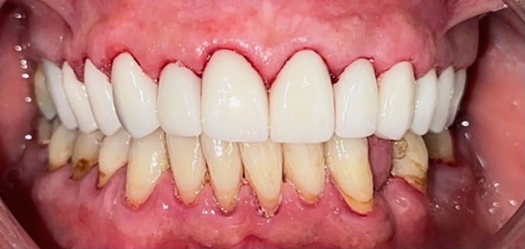 Patient smile after full mouth restoration at Wellness Dental Tucson