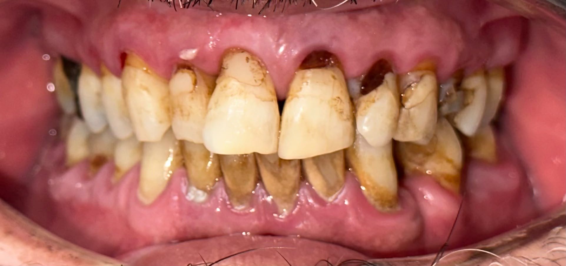 Patient smile before full mouth restoration at Wellness Dental Tucson