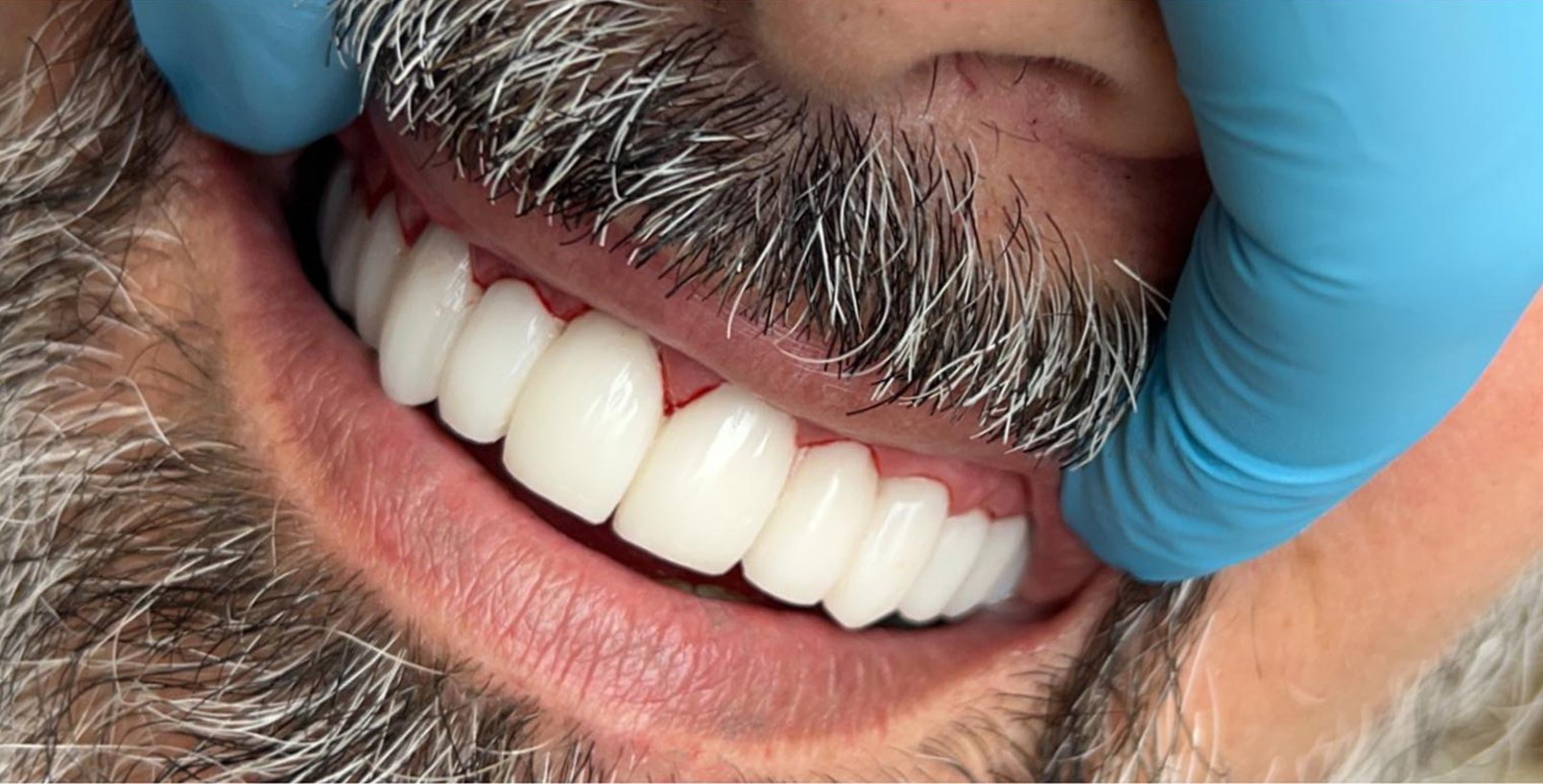 Patient smile after smile design treatment at Wellness Dental Tucson