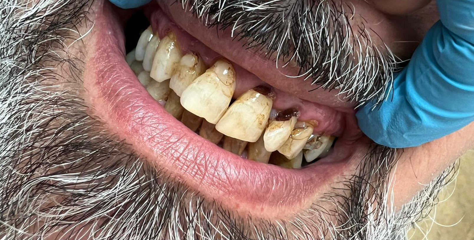 Patient smile before smile design treatment at Wellness Dental Tucson