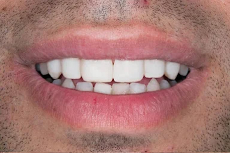 Patient smile after gap closure treatment at Wellness Dental Tucson