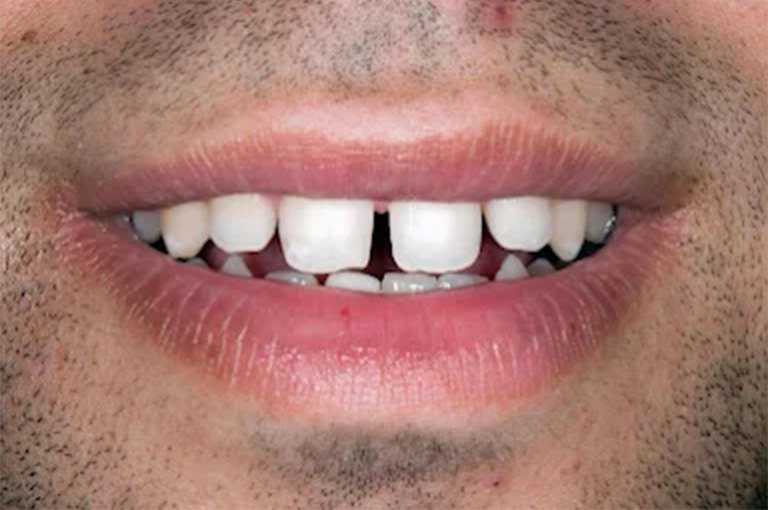 Patient smile before gap closure treatment at Wellness Dental Tucson