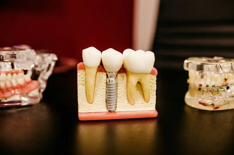 Dental implant model showing a replacement tooth and root